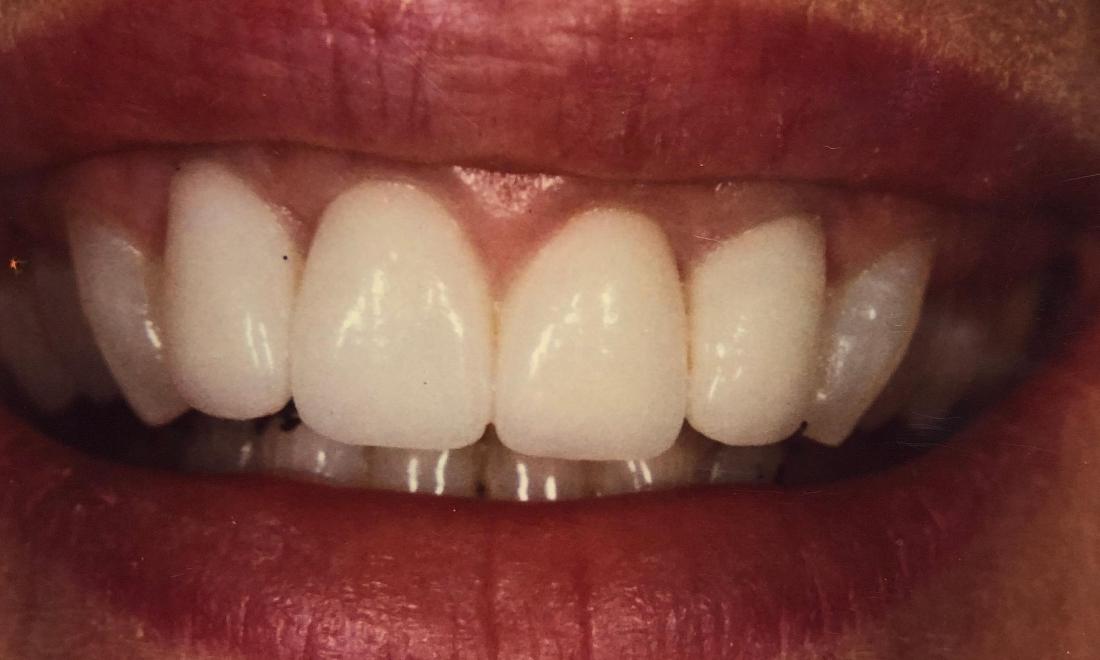 Smile with veneers