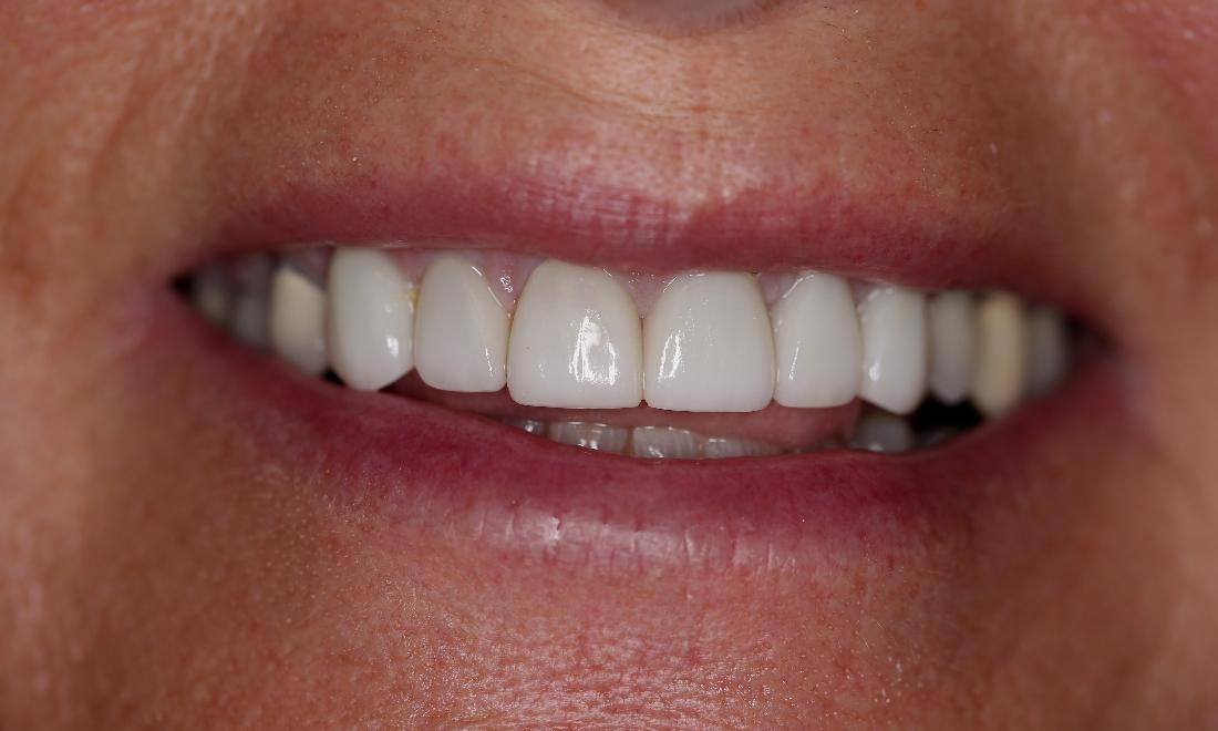 smile with veneers