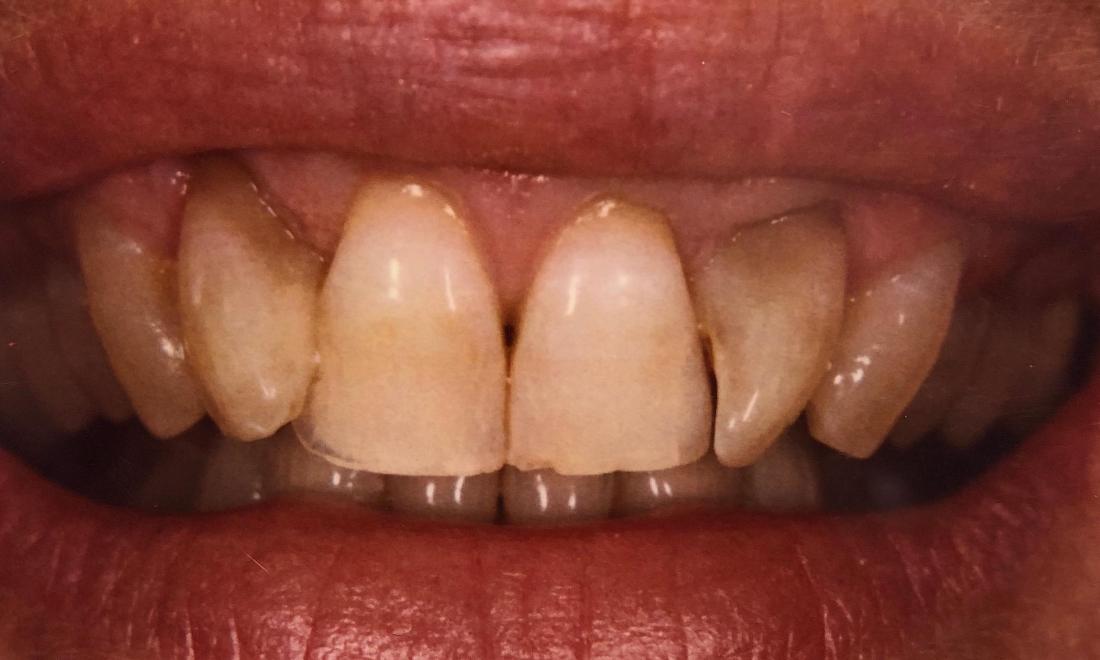 Smiles without veneers