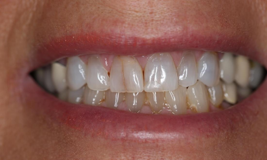 smile without veneers
