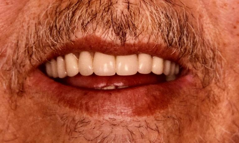 Dentures-After-Image