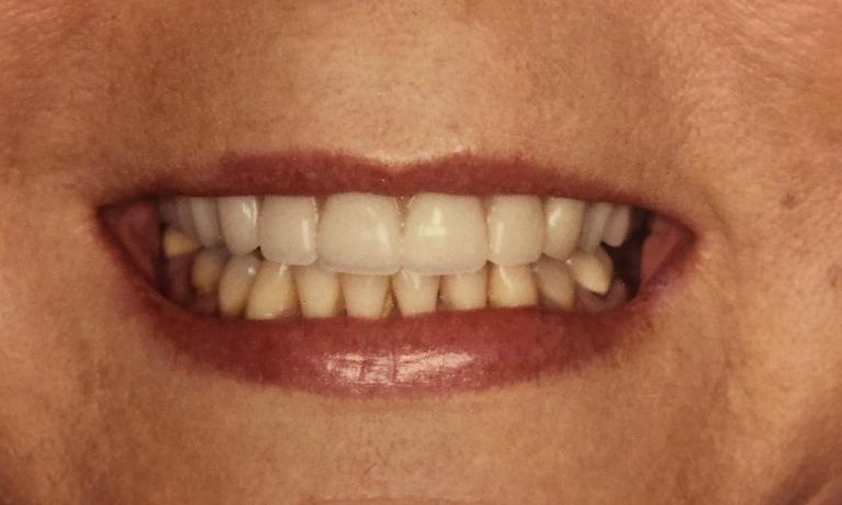 Dentures-After-Image