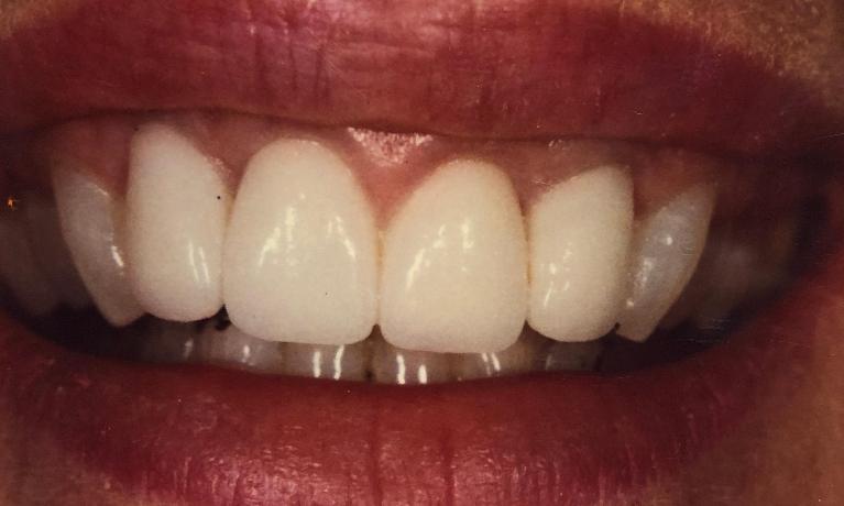 Smile with veneers