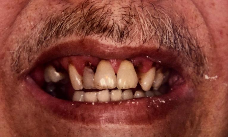 Dentures-Before-Image