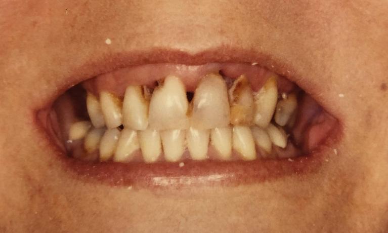 Dentures-Before-Image