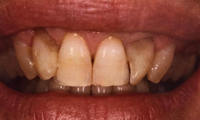 Smiles without veneers